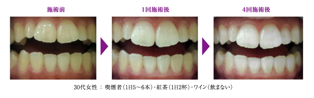 施術前と施術後の比較画像